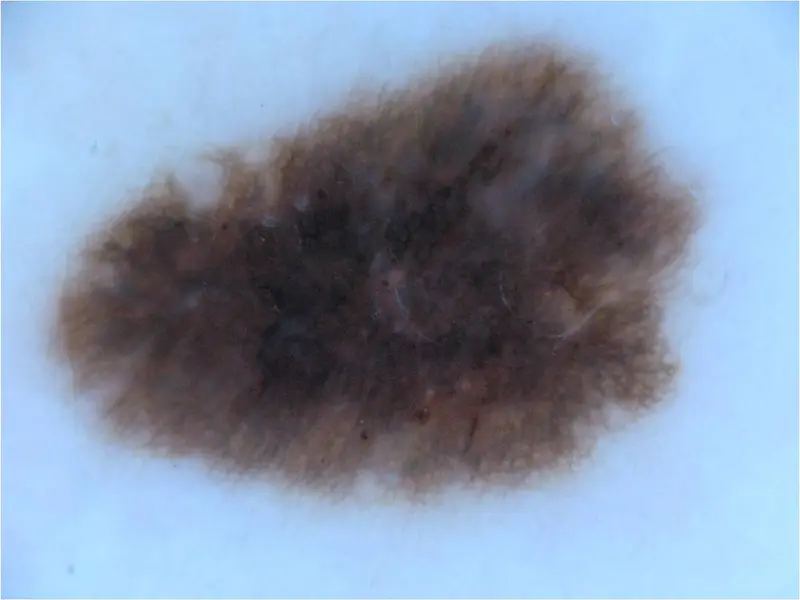 Brown Mole On Skin